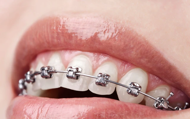 Orthodontie classique par bagues au cabinet du dr Valérie Diop