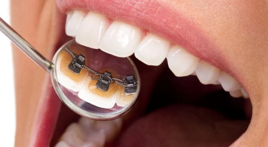 Orthodontie linguale