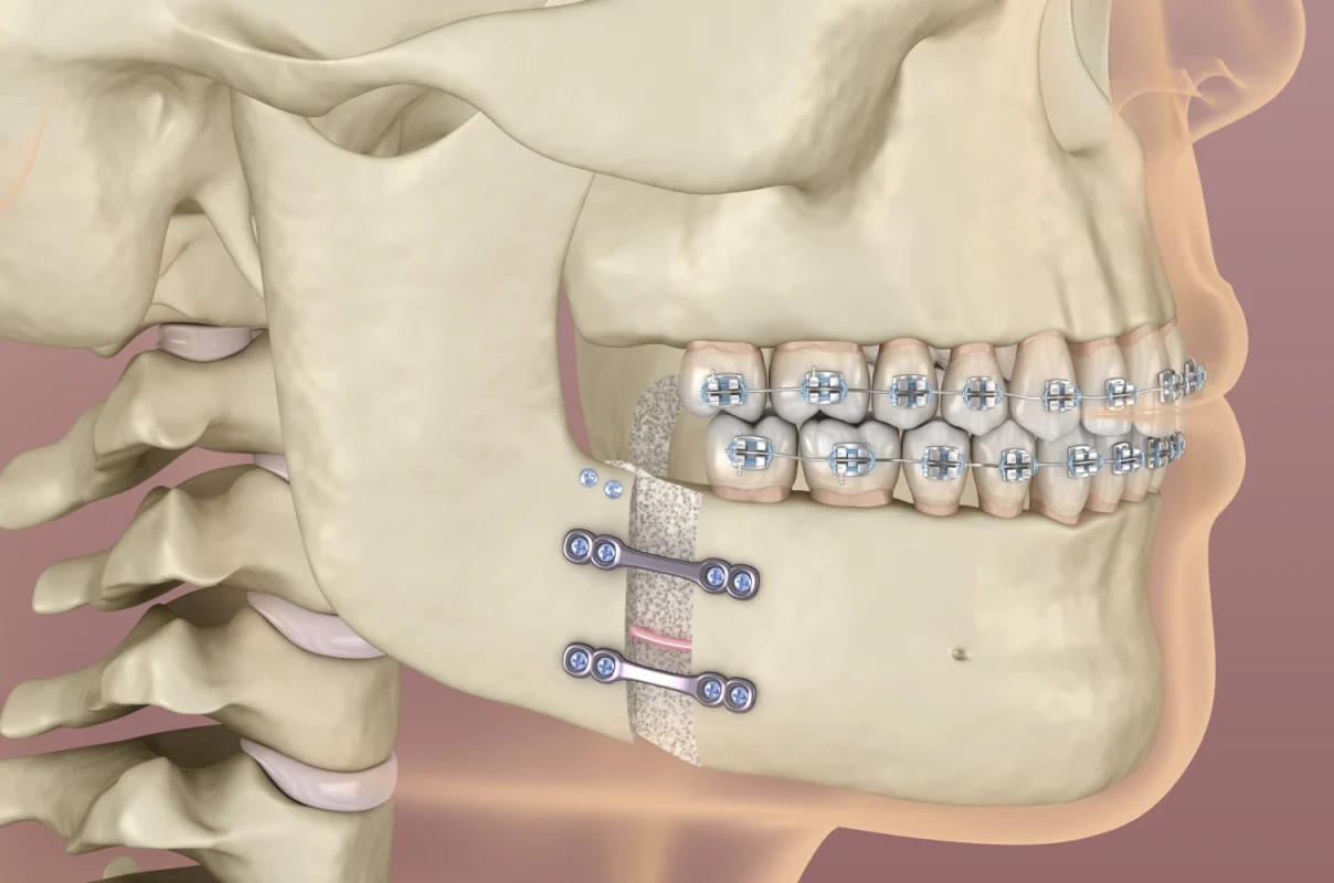 Chirurgie orthognatique au cabinet d'orthodontie du Dr Diop à Colmar