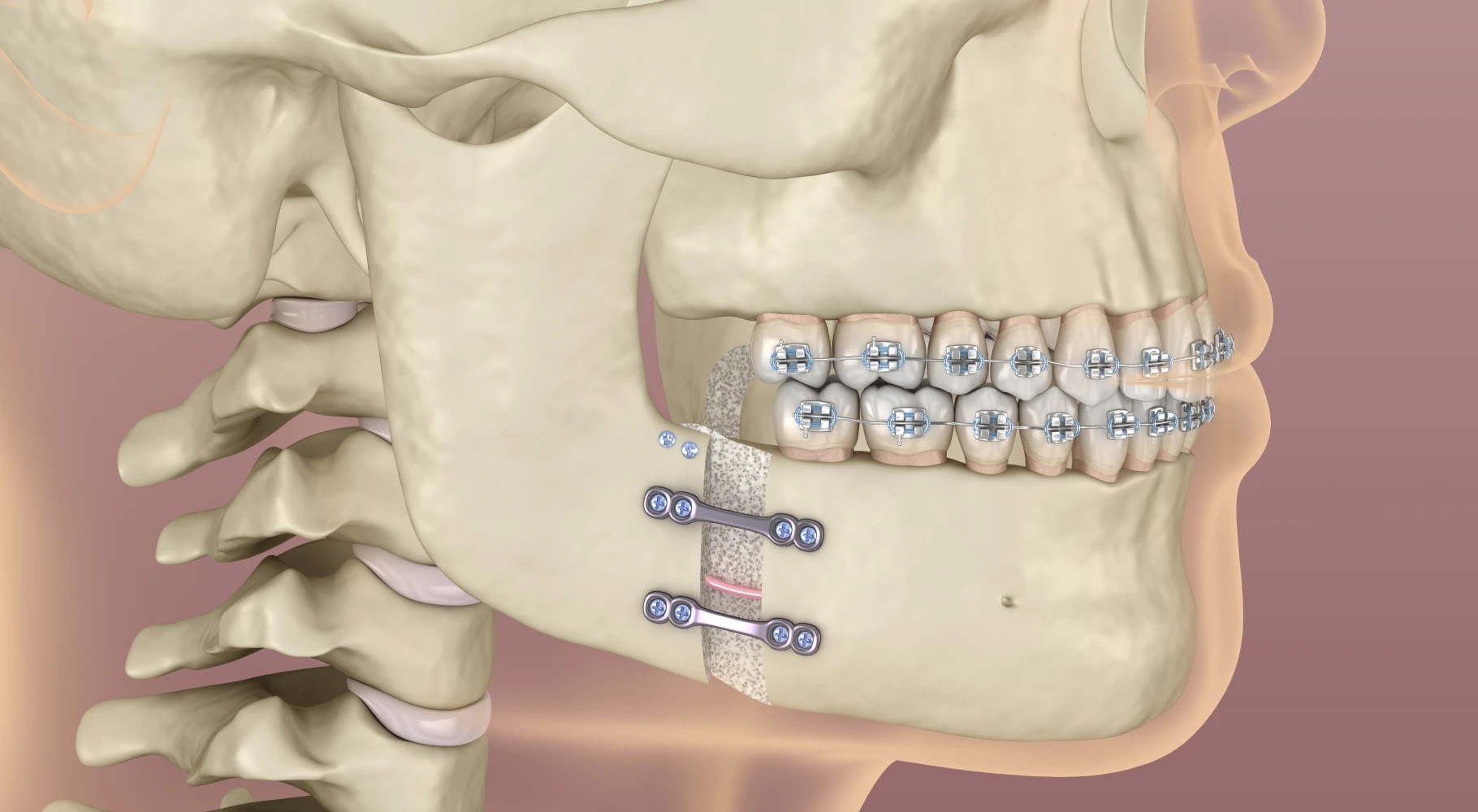 Chirurgie orthognatique pour les défauts transversaux