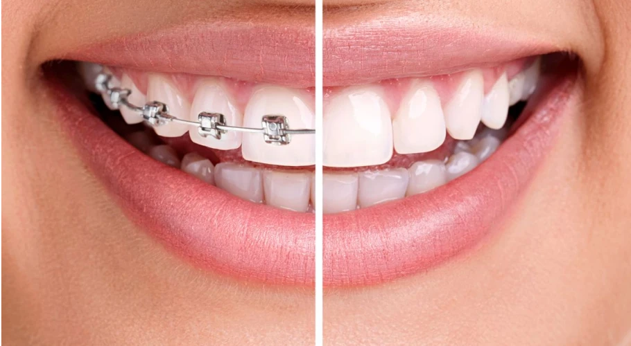 Combien de temps dure un traitement d’orthodontie ?