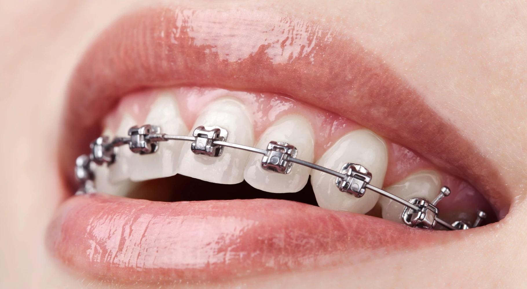 A quoi sert l’orthodontie ?