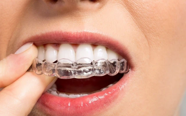 Gouttières invisibles par Orthodontiste spécialiste Dr Diop