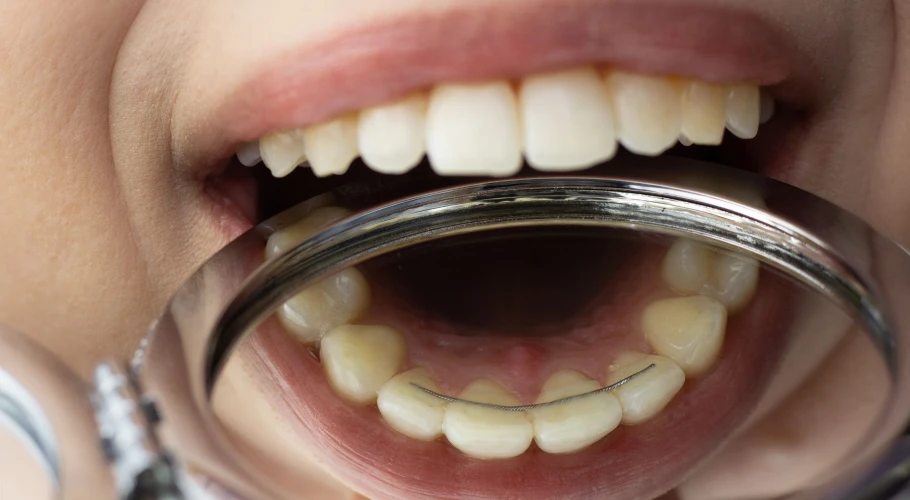 Comment se déroule un traitement d’orthodontie ?